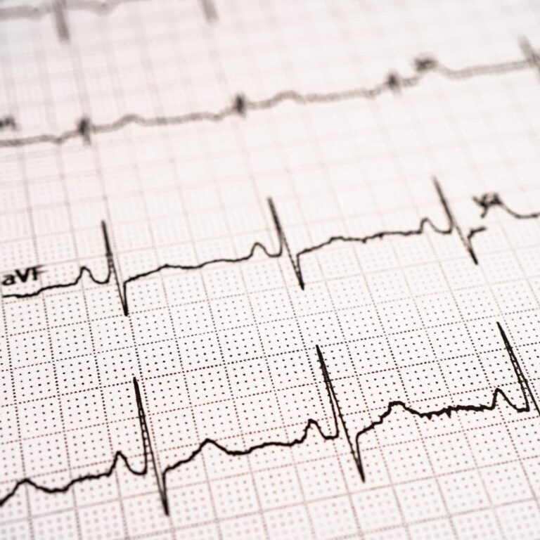 Electrocardiogram ECG, heart wave, heart attack, cardiogram report.